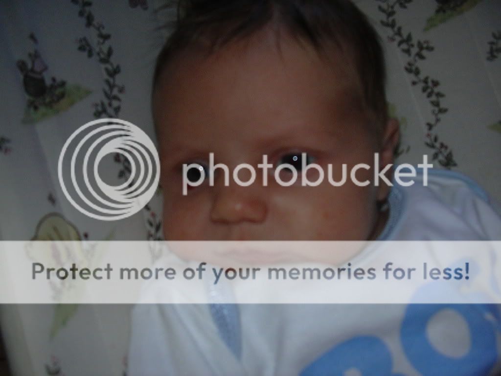 Strawberry birthmark